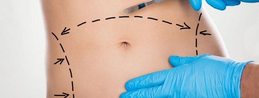 Abdominoplastia