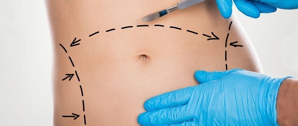 Abdominoplastia