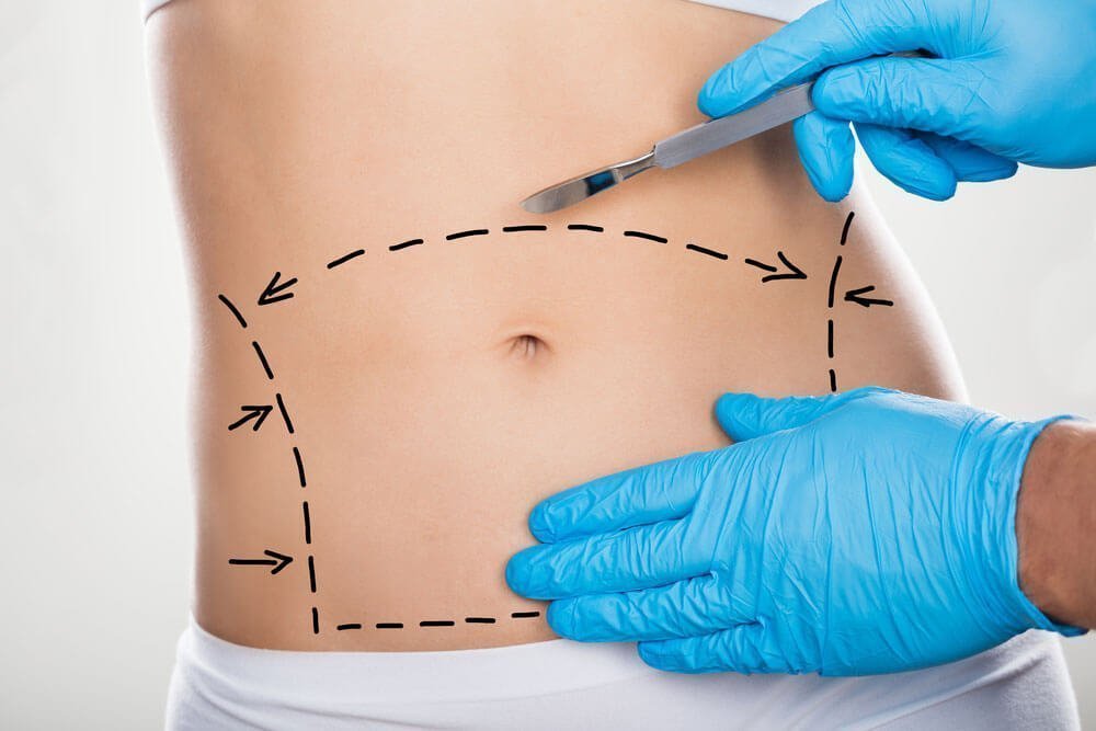 Abdominoplastia