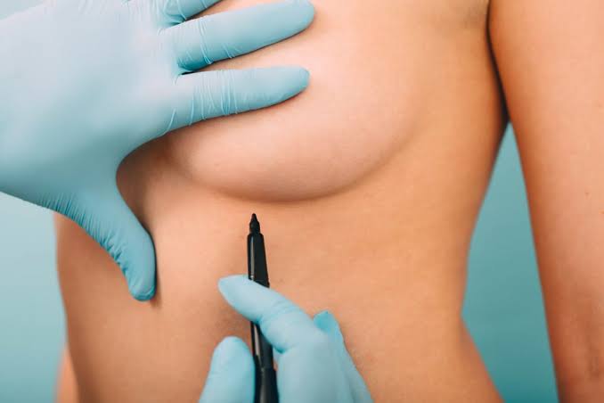 Tudo o que você precisa saber sobre a mamoplastia de aumento