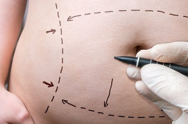 Posso fazer Abdominoplastia mais de uma vez?