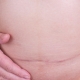 Como é a cicatriz da abdominoplastia?