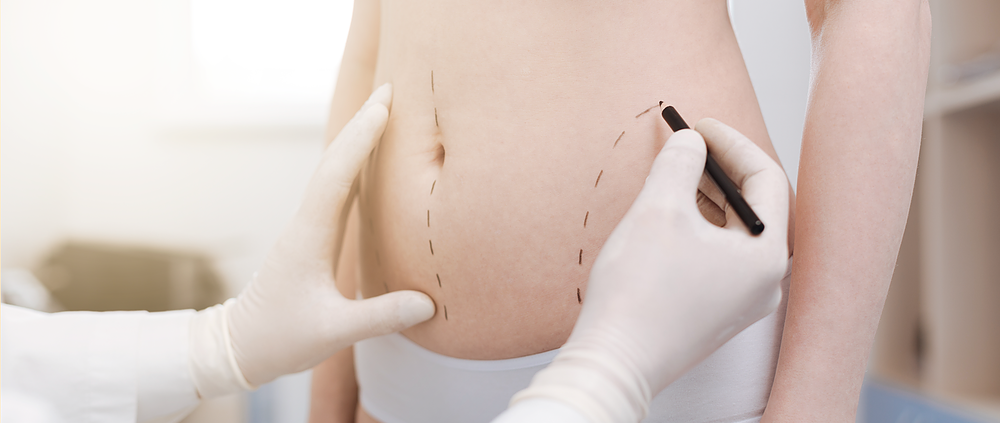 Lipo HD X Lipoescultura: entenda as diferenças