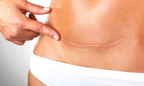 Como cuidar da cicatriz da abdominoplastia