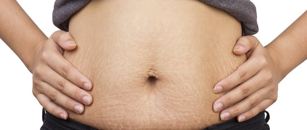 As minhas estrias vão sumir com a abdominoplastia?