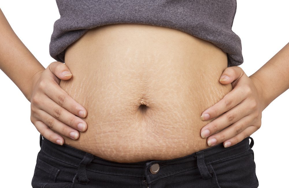 As minhas estrias vão sumir com a abdominoplastia?