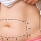 Posso fazer mais de uma abdominoplastia?