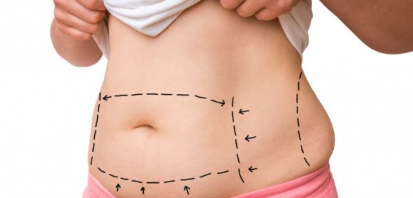 Posso fazer mais de uma abdominoplastia?